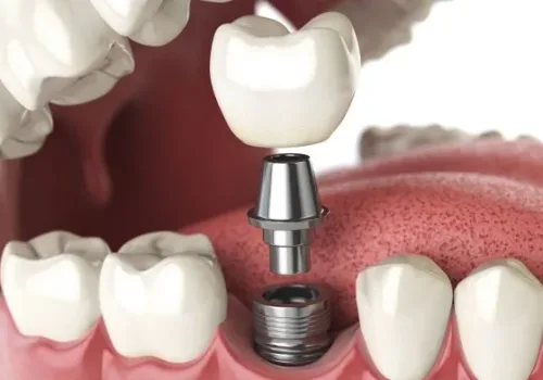 implantes-dentales